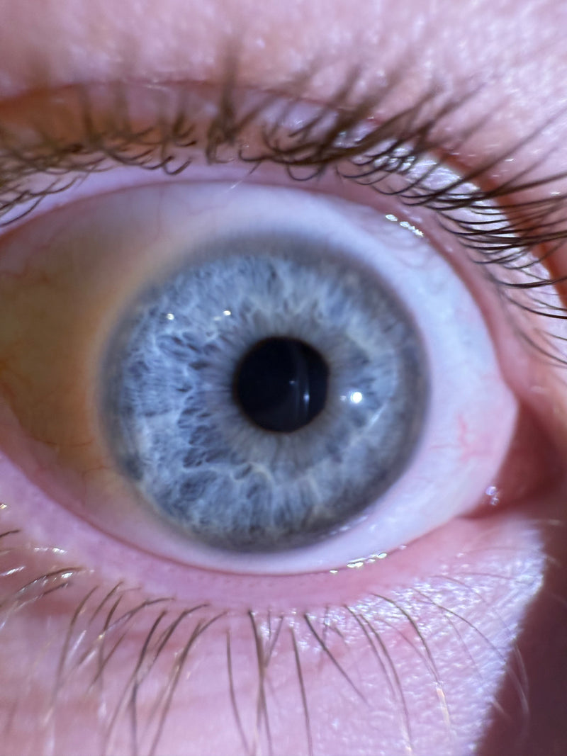The whole iris is visible